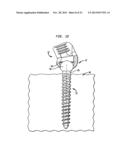 METHODS FOR STABILIZING BONE USING SPINAL FIXATION DEVICES diagram and image