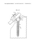 METHODS FOR STABILIZING BONE USING SPINAL FIXATION DEVICES diagram and image