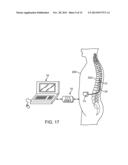 COMBINATION ELECTRICAL STIMULATION AND LOW-LEVEL LASER THERAPY diagram and image