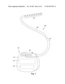 METHODS FOR STIMULATING THE DORSAL ROOT GANGLION WITH A LEAD HAVING     SEGMENTED ELECTRODES diagram and image