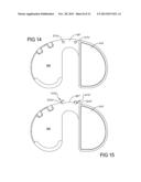 Knee Prosthesis Assembly With Ligament Link diagram and image