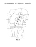 Knee Prosthesis Assembly With Ligament Link diagram and image