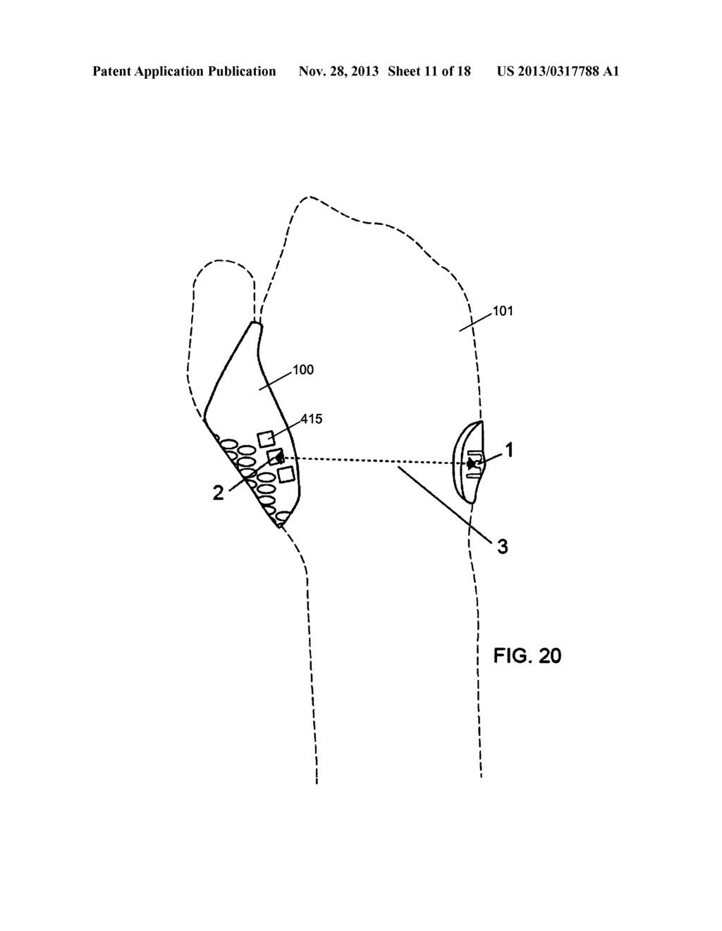 CONFORMAL HAND BRACE - diagram, schematic, and image 12