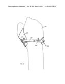 CONFORMAL HAND BRACE diagram and image