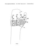 CONFORMAL HAND BRACE diagram and image