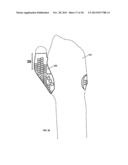 CONFORMAL HAND BRACE diagram and image