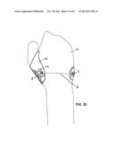 CONFORMAL HAND BRACE diagram and image