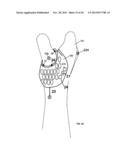 CONFORMAL HAND BRACE diagram and image