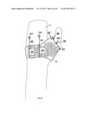 CONFORMAL HAND BRACE diagram and image