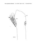 CONFORMAL HAND BRACE diagram and image