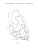 Treating Heart Tissue diagram and image