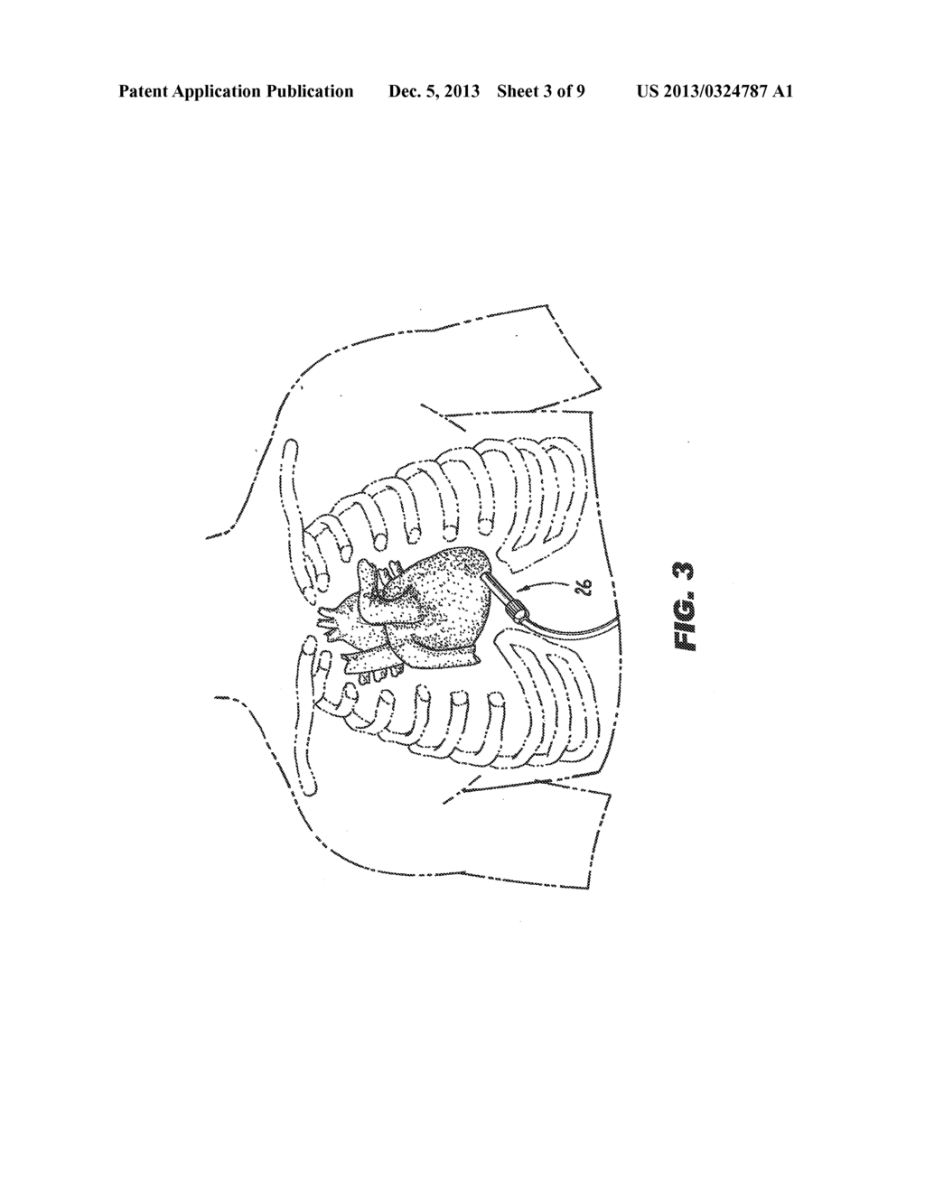 METHOD AND DEVICE FOR PERCUTANEOUS LEFT VENTRICULAR RECONSTRUCTION - diagram, schematic, and image 04