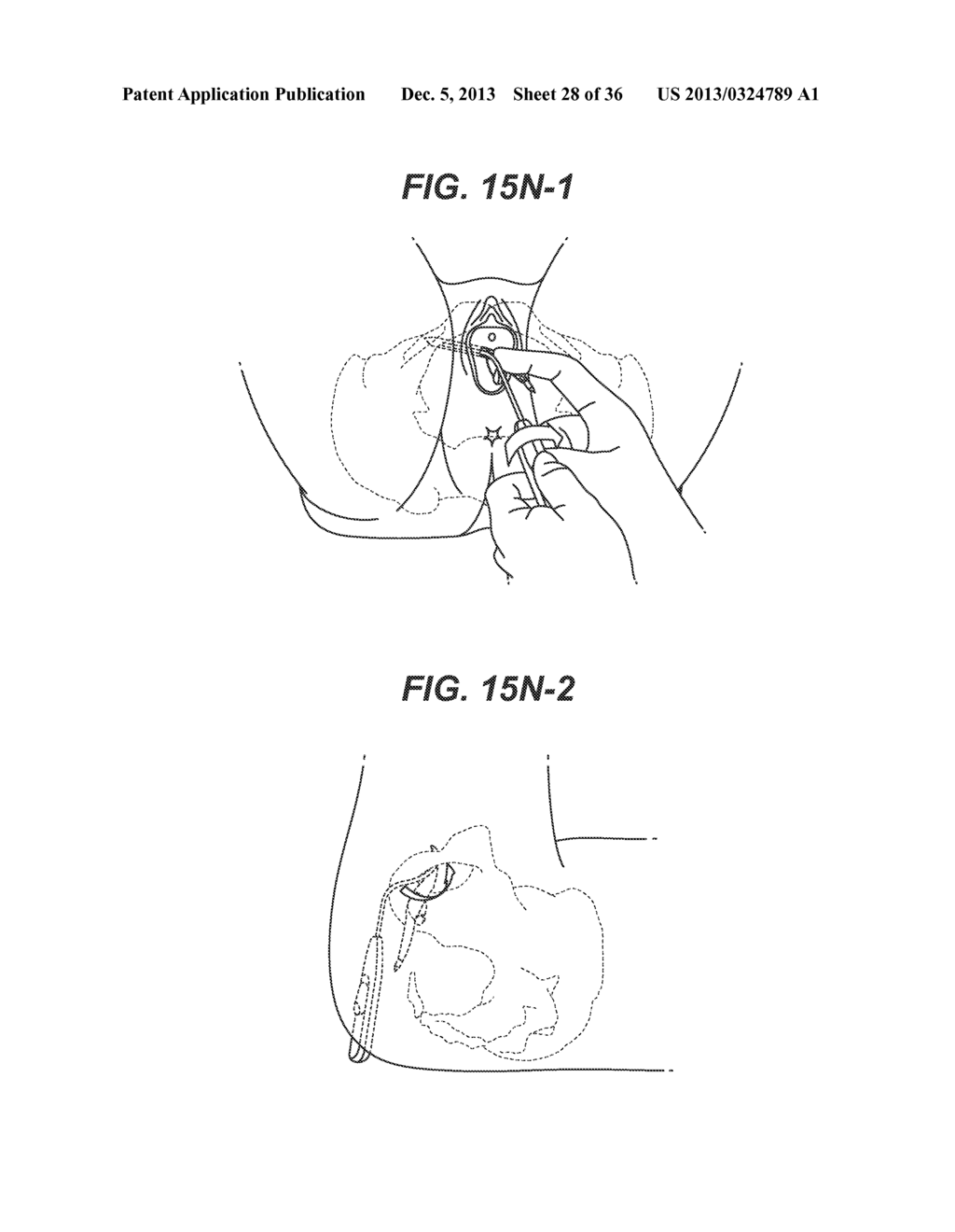 IMPLANT INSERTION SYSTEMS AND METHODS OF USE - diagram, schematic, and image 29