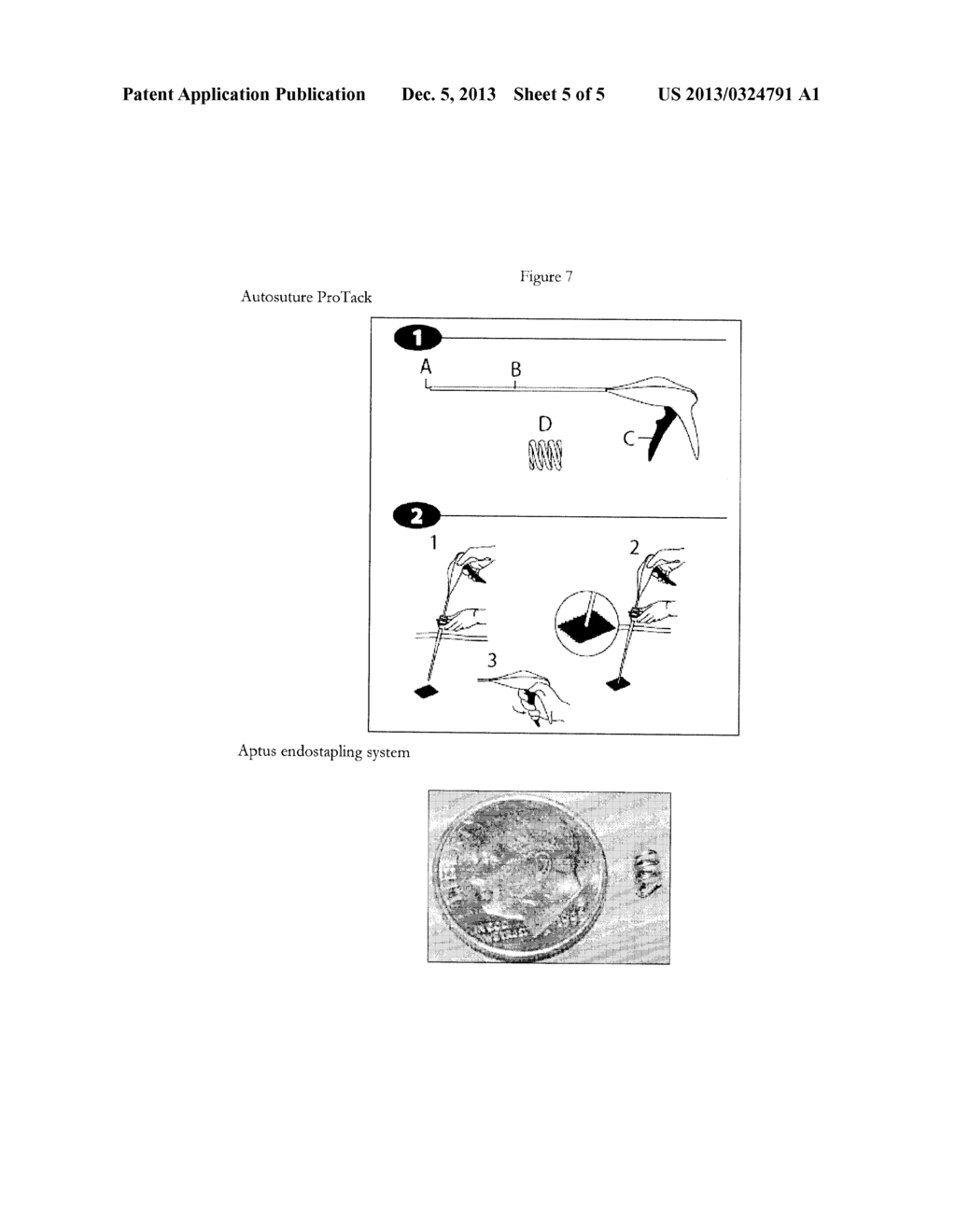 METHOD AND DEVICE FOR TREATING PELVIC ORGAN PROLAPSE - diagram, schematic, and image 06