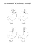 DEVICES AND METHODS FOR GASTROINTESTINAL BYPASS diagram and image