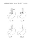 DEVICES AND METHODS FOR GASTROINTESTINAL BYPASS diagram and image