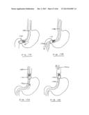 DEVICES AND METHODS FOR GASTROINTESTINAL BYPASS diagram and image