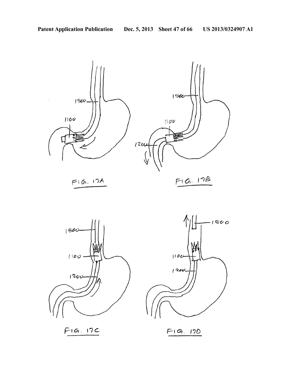DEVICES AND METHODS FOR GASTROINTESTINAL BYPASS - diagram, schematic, and image 48