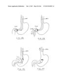 DEVICES AND METHODS FOR GASTROINTESTINAL BYPASS diagram and image