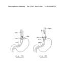 DEVICES AND METHODS FOR GASTROINTESTINAL BYPASS diagram and image