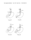 DEVICES AND METHODS FOR GASTROINTESTINAL BYPASS diagram and image