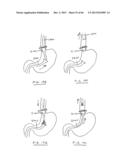 DEVICES AND METHODS FOR GASTROINTESTINAL BYPASS diagram and image