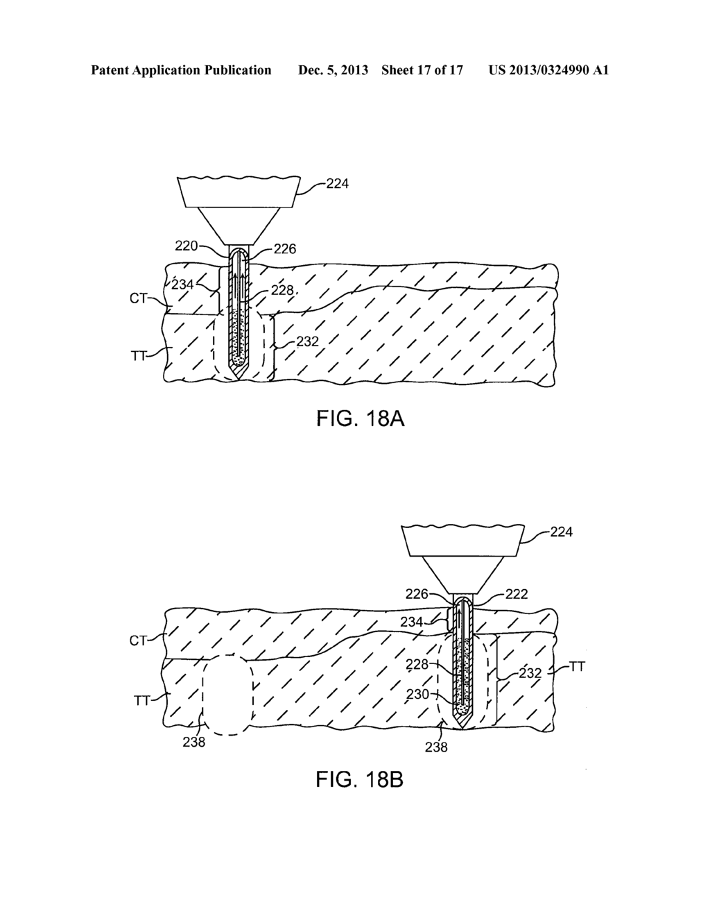 Replaceable and/or Easily Removable Needle Systems for Dermal and     Transdermal Cryogenic Remodeling - diagram, schematic, and image 18