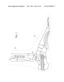 ARTICULATED INTRAMEDULLARY NAIL diagram and image