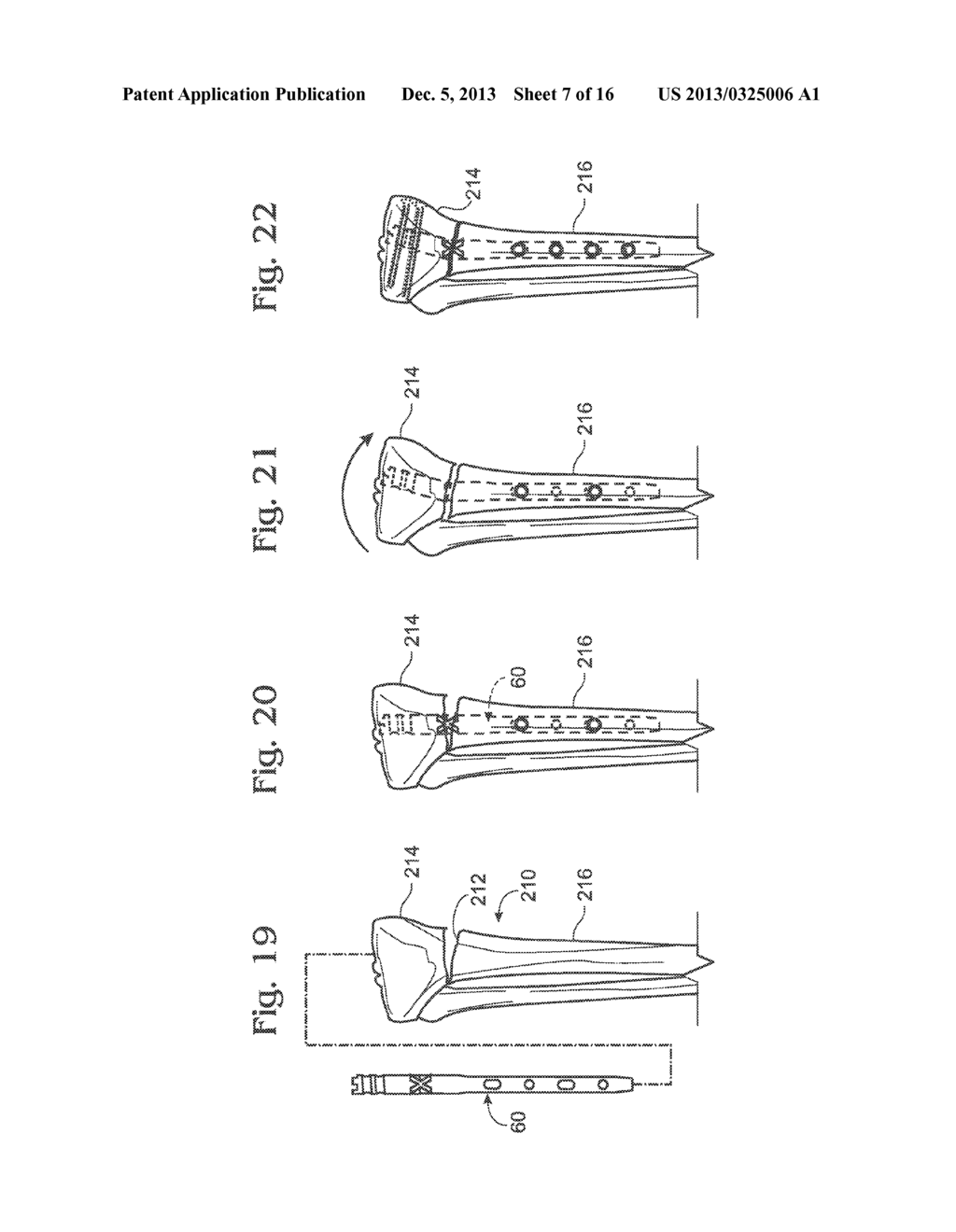 ARTICULATED INTRAMEDULLARY NAIL - diagram, schematic, and image 08