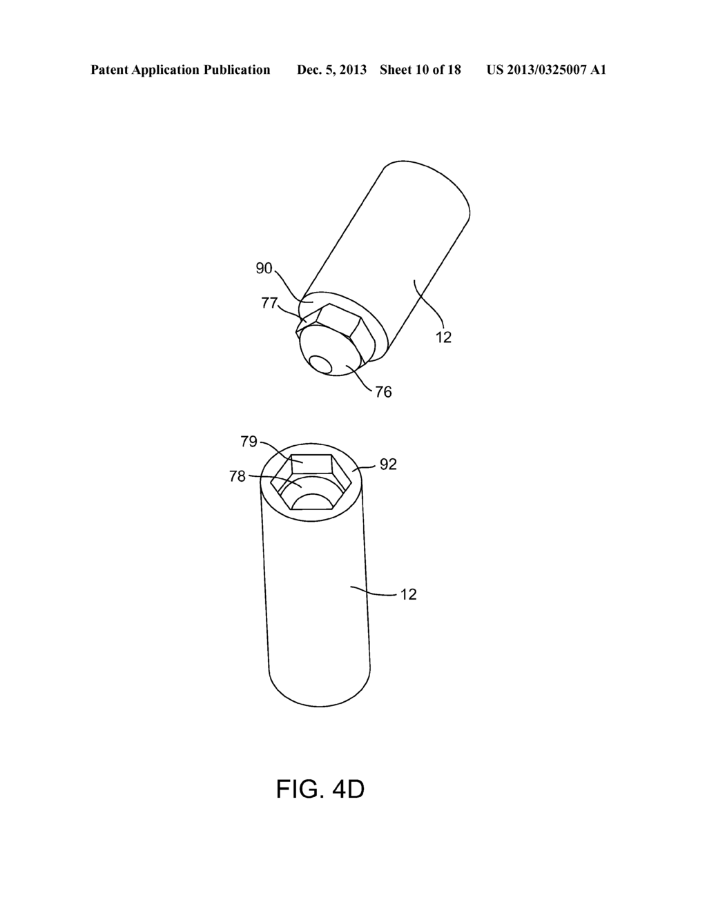 SEGMENTED INTRAMEDULLARY IMPLANT - diagram, schematic, and image 11