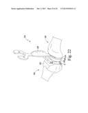 METHOD OF SURGICALLY PREPARING A PATIENT S FEMUR diagram and image