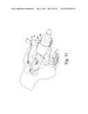 METHOD OF SURGICALLY PREPARING A PATIENT S FEMUR diagram and image