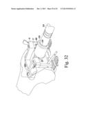 FEMORAL ORTHOPAEDIC SURGICAL INSTRUMENTS AND  METHOD OF USE OF SAME diagram and image