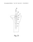 TIBIAL ORTHOPAEDIC SURGICAL INSTRUMENTS AND METHOD OF USING SAME diagram and image