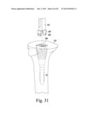 TIBIAL ORTHOPAEDIC SURGICAL INSTRUMENTS AND METHOD OF USING SAME diagram and image