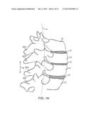 SPINOUS PROCESS CERCLAGE FOR BONE GRAFT CONTAINMENT diagram and image