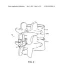 SPINOUS PROCESS CERCLAGE FOR BONE GRAFT CONTAINMENT diagram and image