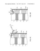 SPINOUS PROCESS CERCLAGE FOR BONE GRAFT CONTAINMENT diagram and image