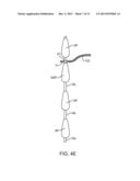 SPINOUS PROCESS CERCLAGE FOR BONE GRAFT CONTAINMENT diagram and image