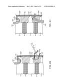 SPINOUS PROCESS CERCLAGE FOR BONE GRAFT CONTAINMENT diagram and image