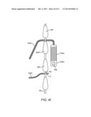 SPINOUS PROCESS CERCLAGE FOR BONE GRAFT CONTAINMENT diagram and image