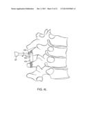 SPINOUS PROCESS CERCLAGE FOR BONE GRAFT CONTAINMENT diagram and image