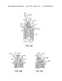 SPINOUS PROCESS CERCLAGE FOR BONE GRAFT CONTAINMENT diagram and image