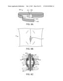 SPINOUS PROCESS CERCLAGE FOR BONE GRAFT CONTAINMENT diagram and image