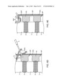 SPINOUS PROCESS CERCLAGE FOR BONE GRAFT CONTAINMENT diagram and image