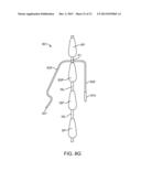 SPINOUS PROCESS CERCLAGE FOR BONE GRAFT CONTAINMENT diagram and image