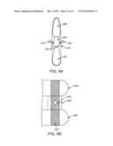 SPINOUS PROCESS CERCLAGE FOR BONE GRAFT CONTAINMENT diagram and image