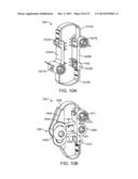 SPINOUS PROCESS CERCLAGE FOR BONE GRAFT CONTAINMENT diagram and image