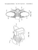 SPINOUS PROCESS CERCLAGE FOR BONE GRAFT CONTAINMENT diagram and image