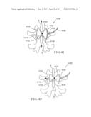 PERCUTANEOUS SPINAL IMPLANTS AND METHODS diagram and image